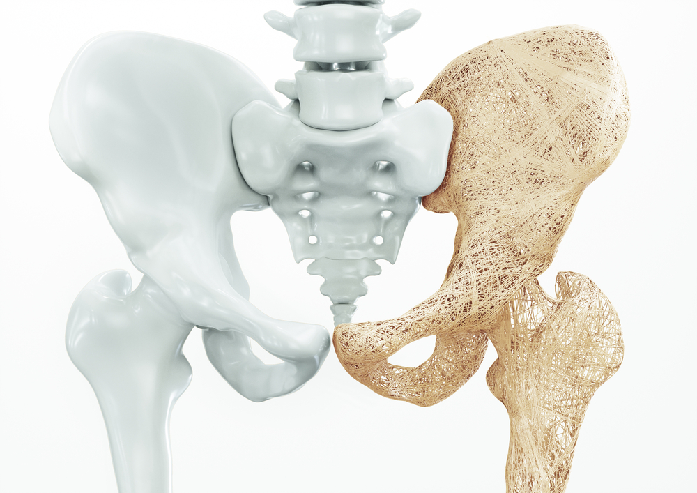 Osteoporosis hip bones