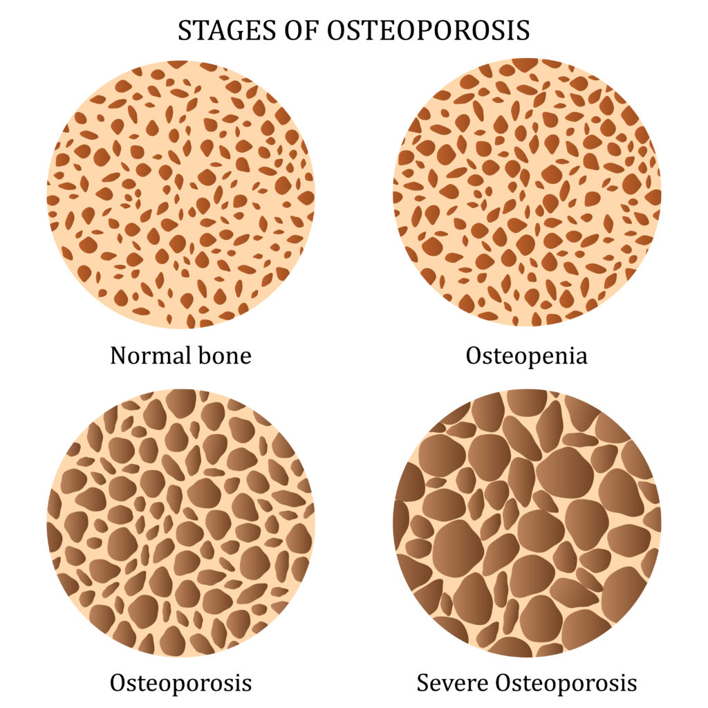 Medical illustration of healthy bone and bones with different stages of osteoporosis.